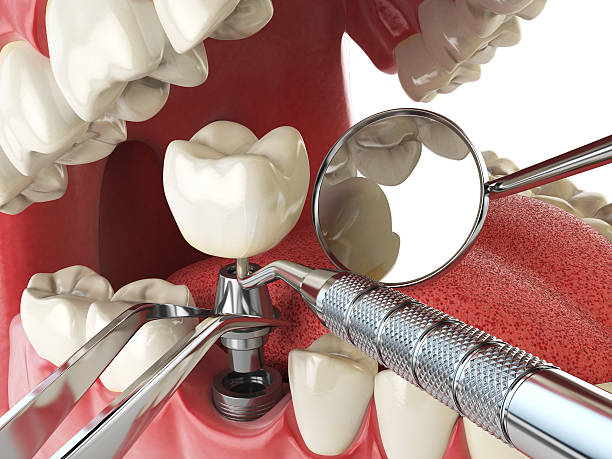 Best Emergency Tooth Extraction in Monrovia, MD